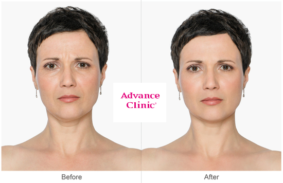 Anti wrinkle treatment