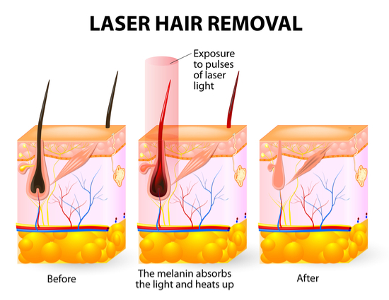 Laser hair reduction